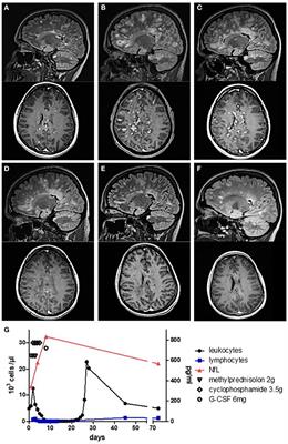 Case Report: Successful Stabilization of Marburg Variant Multiple Sclerosis With Ocrelizumab Following High-Dose Cyclophosphamide Rescue